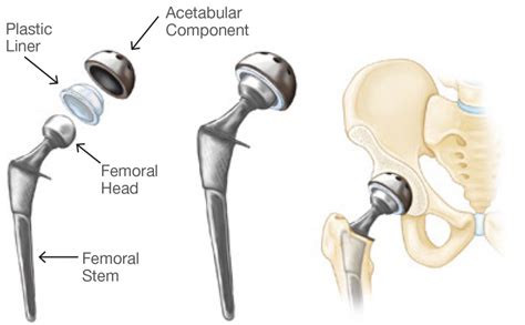 Total Hip Replacement Orthodoctor Waverley Orthopaedic Clinic