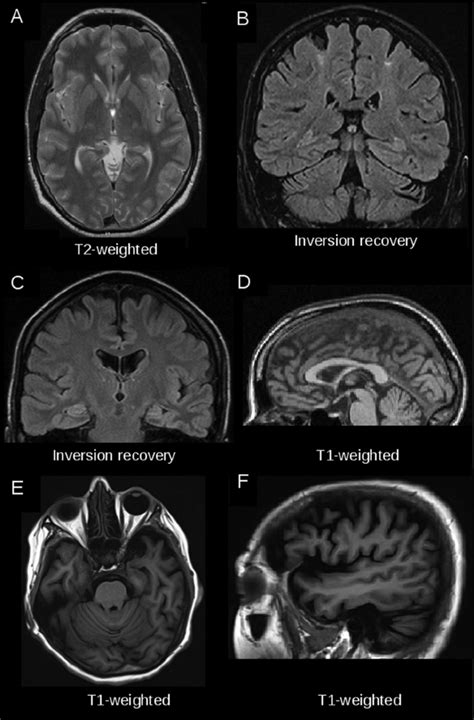 Examples Of Magnetic Resonance Imaging Mri Findings In Individual