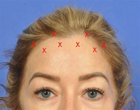 The Botox® Brow Lift Revisited W Cosmetic Surgery Botox Brow Lift