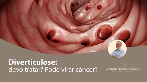 Diverticulose devo tratar Pode virar câncer Prof Dr Luiz