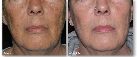 Skin Discoloration Treatment Revive Skin Clinic Of Maine