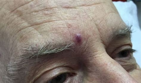 Derm Dx Asymptomatic Lesion On The Forehead Dermatology Advisor