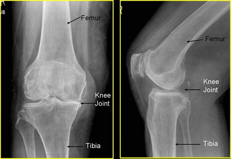 Knee Replacements