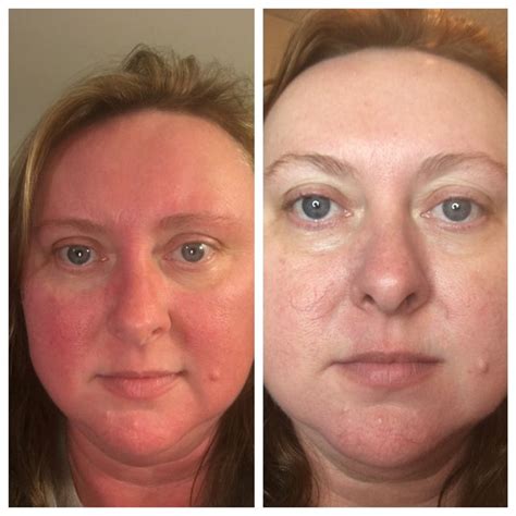 These Results After Only A Week Of The Soothe Regimen For Her Rosacea