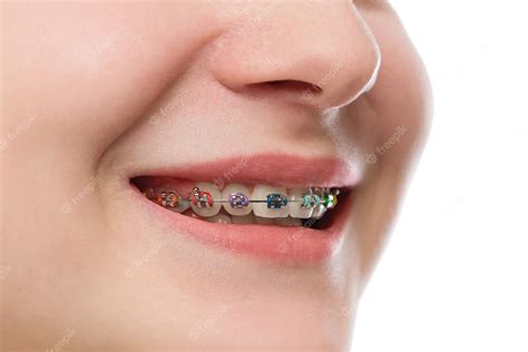 premium photo closeup multicolored braces on teeth beautiful female smile portrait with
