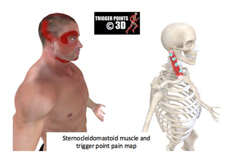 Trigger Point Of The Week Sternocleidomastoid