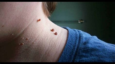 7 easy ways to remove skin tags without seeing a doctor youtube