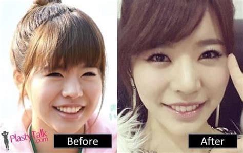 Snsd Tiffany Before And After Plastic Surgery