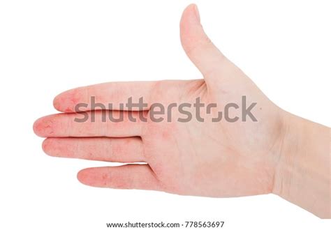 Womans Hand Wounds Eczema Dermatitis Stock Photo 778563697 Shutterstock