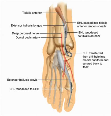 Figure From Repair Of Chronic Tibialis Anterior Tendon Ruptures My Xxx Hot Girl