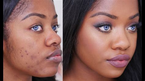 Causes Of Acne Breakouts In Black Women Fabwoman