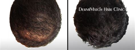 How To Treat An Uneven Hairline Dermimatch Hair Clinic Scalp