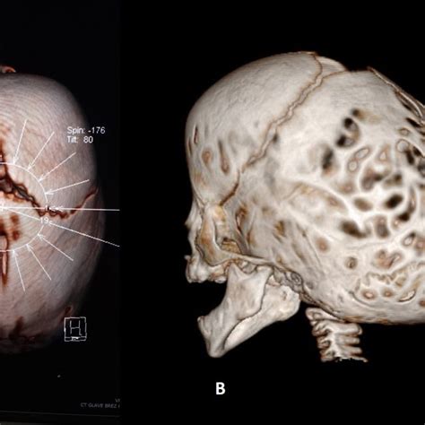 Ct Appearance Of Two Cases Of Sagittal Suture Synostosis In These