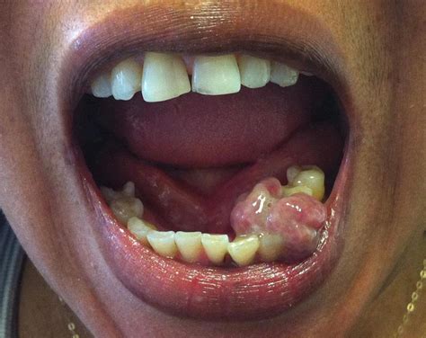 Mouth Cancer Pre Malignant Conditions Mr Luke Cascarini