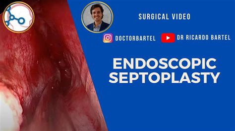 Endoscopic Septoplasty For Septal Deviation Youtube