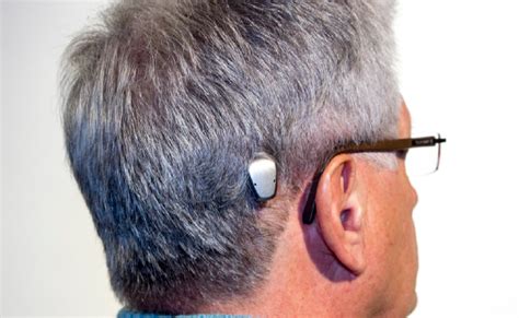 Bone Conduction Implant Norwest Hearing