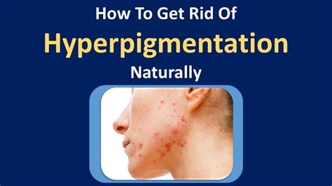 How To Get Rid Of Hyperpigmentation Naturally Apple Cider Vinegar