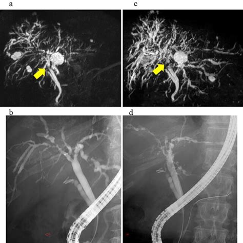 figure1 magnetic resonance cholangiopancreatography mrcp and download scientific diagram