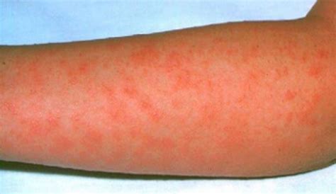 Scarlet Fever Cases Continue To Rise In Hinckley Hinckley Times