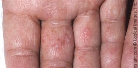 Dyshidrotic Eczema Fingers Dorothee Padraig South Wes
