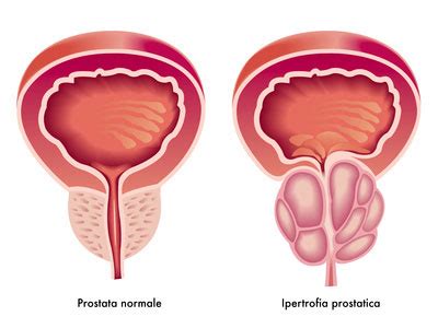 E poi la frutta ricca di. Prostata Ingrossata: 8 Passi per Iniziare a Guarire!