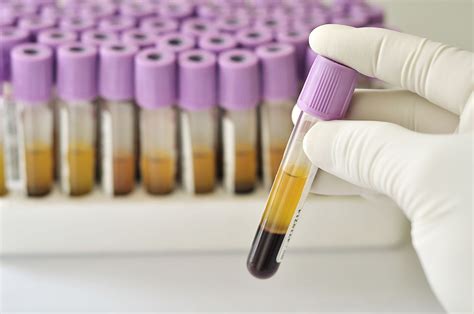 New Blood Test Can Differentiate Between Pancreatic Cancer And Chronic