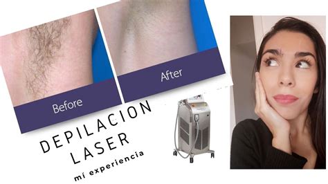 Depilaci N L Ser Todo Lo Que Ten S Q Saber Laser Hair Removal Everything You Have To Know