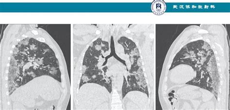 The main symptoms of coronavirus are: *CT scan of the chest of a patient infected with Corona ...