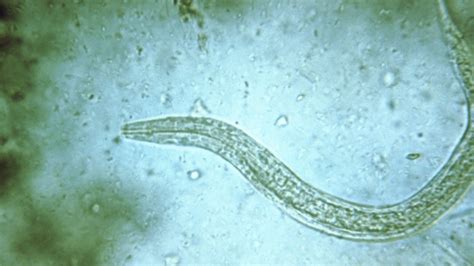 Womans Headache Caused By Tapeworm Larvae In Brain Case Report