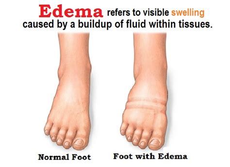 Difference Between Pitting Edema And Non Pitting Edema The Scientific