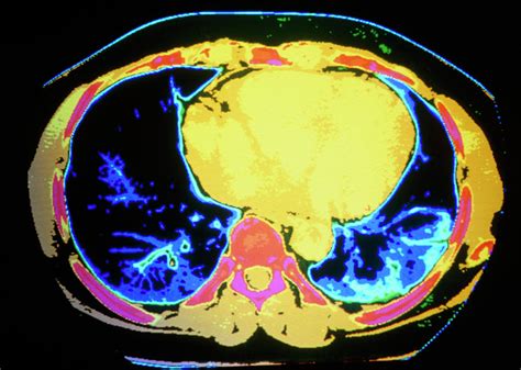 Coloured Ct Scan Showing Cancer Of Lung Photograph By Gcascience Photo