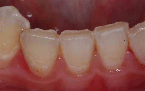 Tooth Wear Glendale Az Dentist Dr Lee Ann Brady