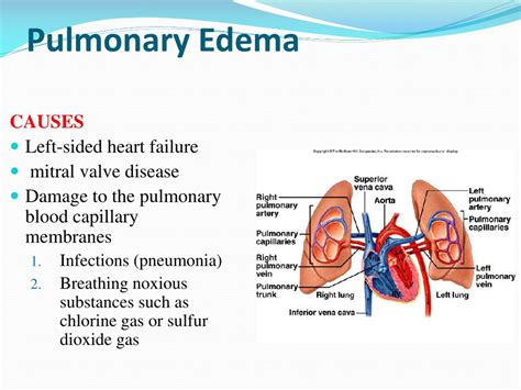 Ppt Chapter 38 Pulmonary Circulation Pulmonary Edema Pleural Fluid