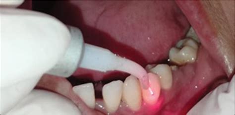 Treatment Of Aggressive Periodontitis With Photodynamic Therapy And