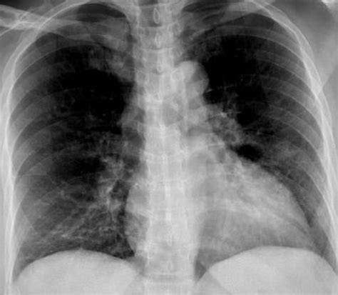 Cureus Can Mediastinal Lymphadenopathy Signal Pericarditis