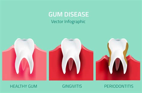 A malignant tumour is a cancerous mass or lump of tissue that may resemble swelling. How to Tell if You Have Gum Disease | Dr. Kevin Sands