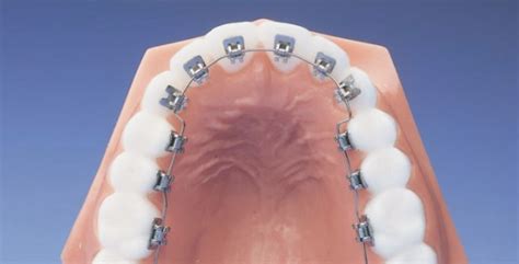 In Ovation® Lingual Braces Invisible Braces Firouz Orthodontics