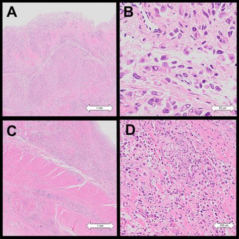 Histopathological Findings From The Autopsy Hematoxylin And Eosin