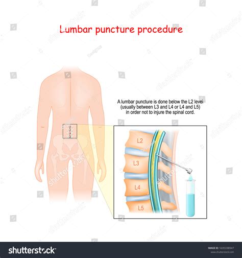 Lumbar Puncture Over 174 Royalty Free Licensable Stock Illustrations