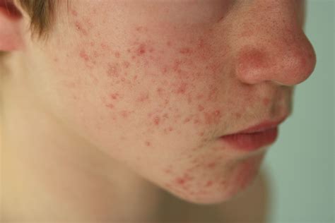 Signs And Symptoms Of Mild Acne Acne Symptoms