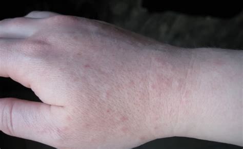 Rashes In Hands Pictures Photos