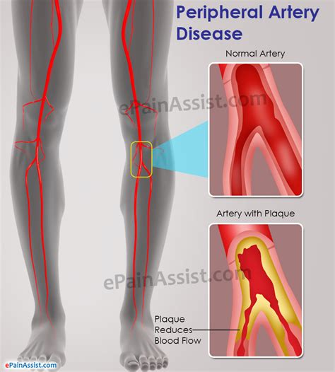 Peripheral Artery Diseasecausessymptomstreatmentdos And Donts