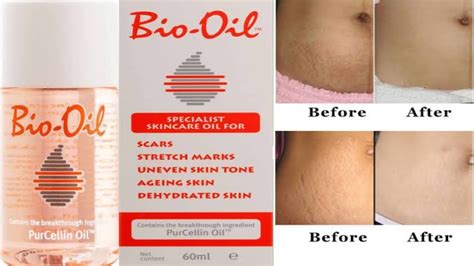 Bio Oil Effctive In Stretch Marks My Honest Review And My Experience