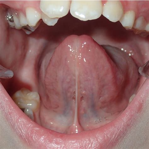 Tongue Tie Yamin Orthodontics