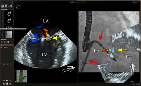 Fusion Imaging For Transcatheter Mitral Valve Repair Mitraclip