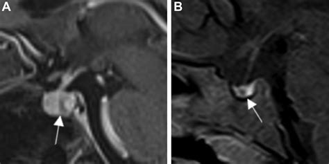 Pituitary Tumors In Children Advances In Pediatrics