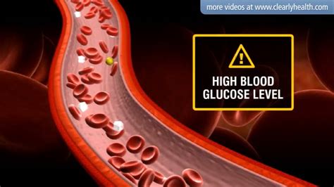 Manolakou p., angelopoulou r., bakoyiannis c., bastounis e. Diabetes: Insulin's side effects - YouTube