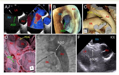 Figure 1 From Staged Transcatheter Closure For Atrial Septal Defect And
