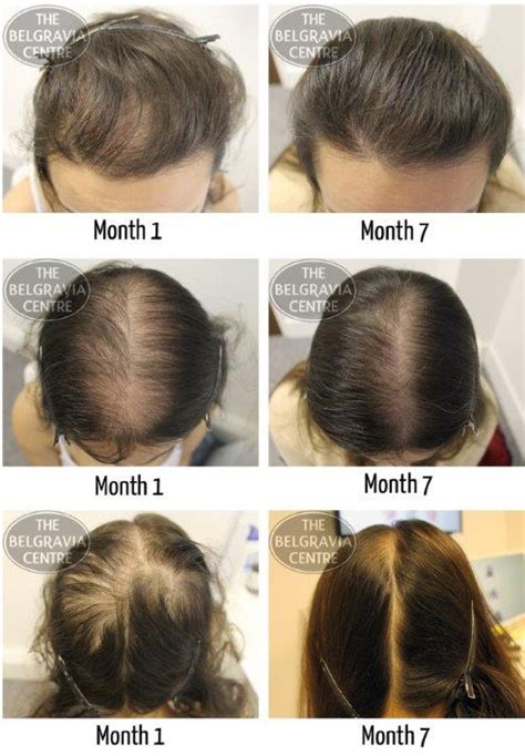 Womens Hair Loss Treatment Success Stories