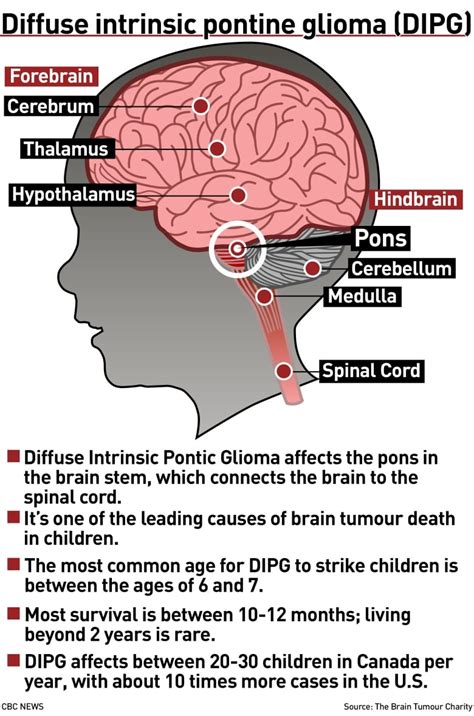 Childhood Brain Tumors New Cause Of Child Brain Tumor Condition